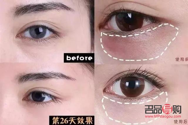 公认最好用10大眼膜(去眼袋公认最好用10大眼膜)