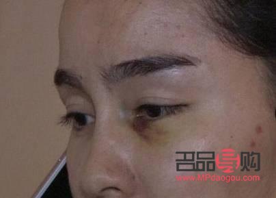 美容院怎样除泪沟(美容院泪沟的治疗方法哪种最好)