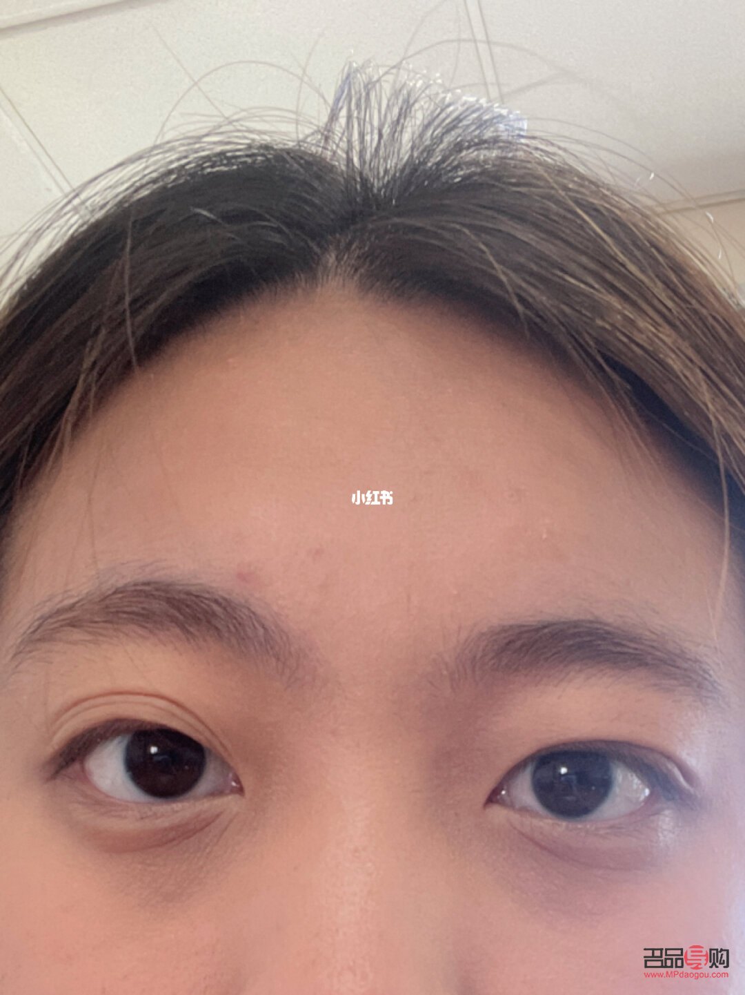 三眼皮怎么变回双眼皮(三眼皮怎么变回双眼皮学生) 三眼皮怎么变回双眼皮(三眼皮怎么变回双眼皮学生)