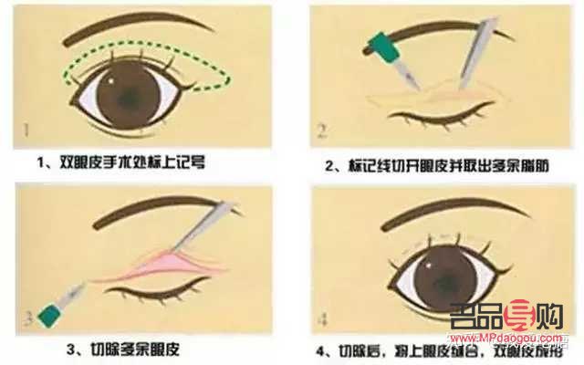 三眼皮怎么变回双眼皮(三眼皮怎么变回双眼皮学生)