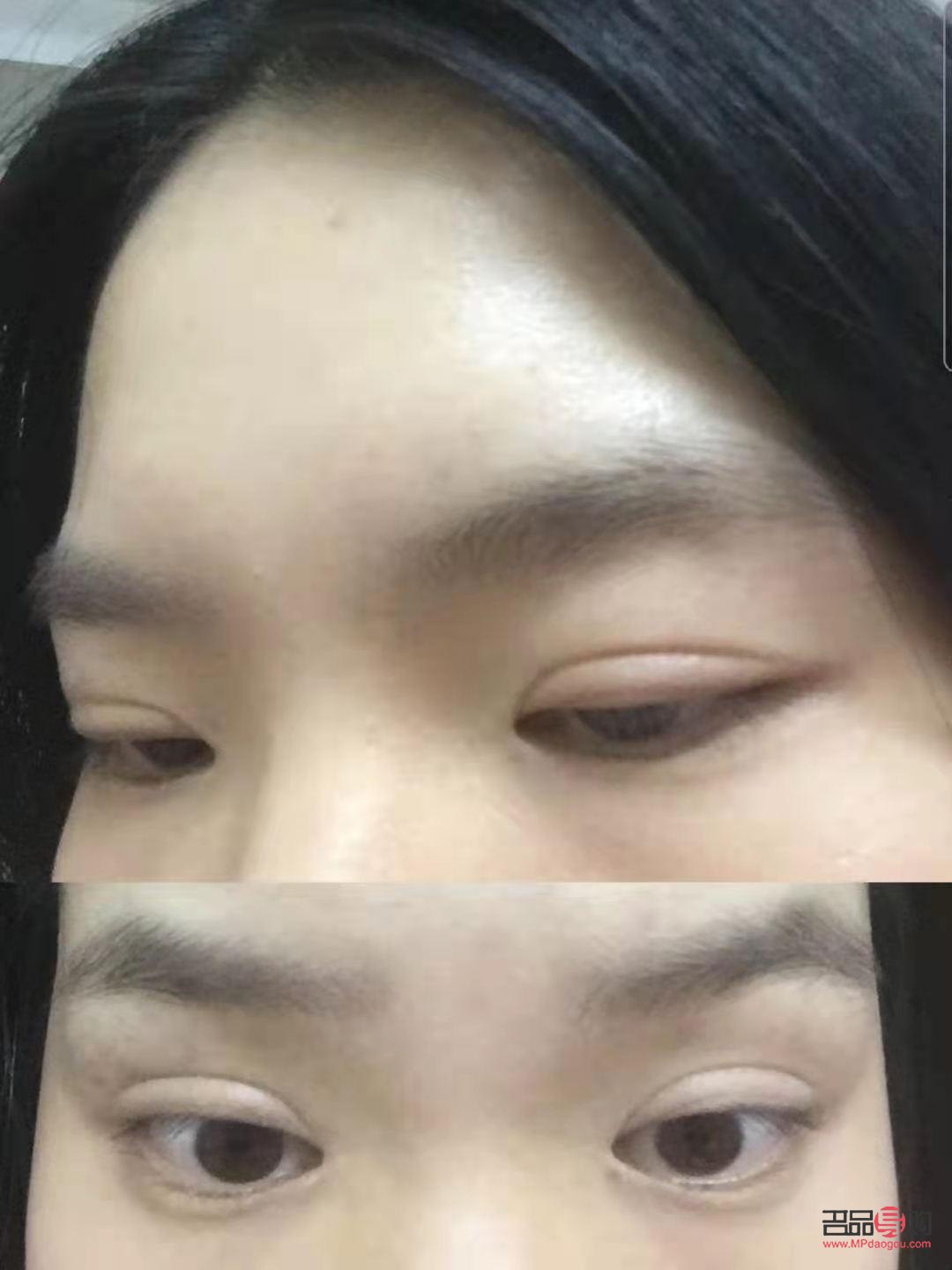 肿眼泡怎么消失(肿眼泡怎么消失了)