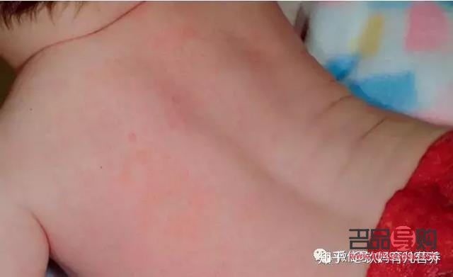 <h3>热疹护理全攻略：守护肌肤健康，远离热疹困扰</h3>