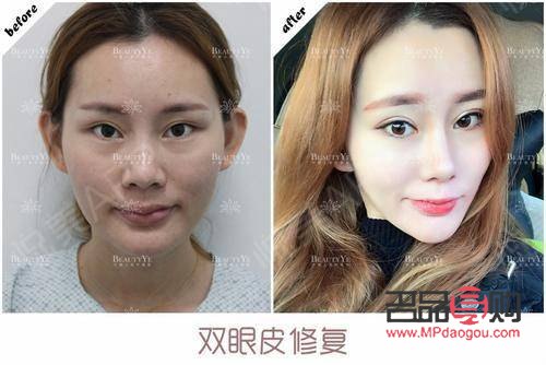 <h3>双眼皮割窄了如何修复?专业指导与解决方案</h3> <h3>双眼皮割窄了如何修复?专业指导与解决方案</h3>