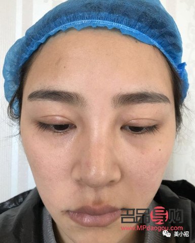 <h3>双眼皮割窄了如何修复?专业指导与解决方案</h3> <h3>双眼皮割窄了如何修复?专业指导与解决方案</h3>