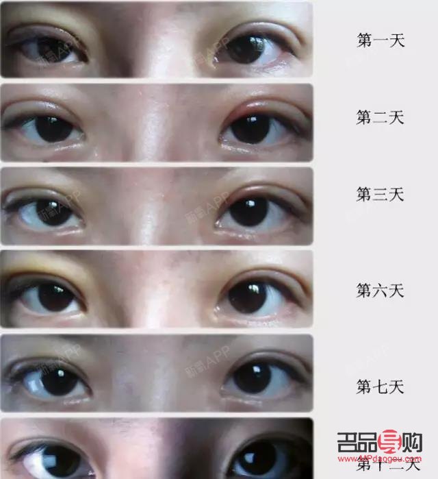 <h3>双眼皮割窄了如何修复?专业指导与解决方案</h3> <h3>双眼皮割窄了如何修复?专业指导与解决方案</h3>