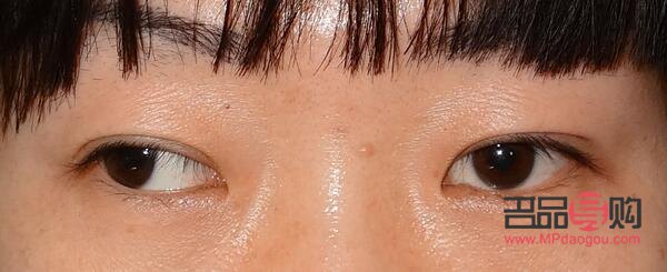 眼球偏移可以矫正吗(眼球偏移可以矫正吗多少钱)