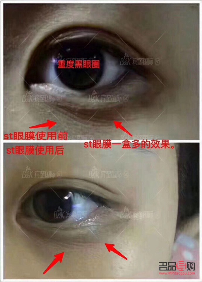 一张图教你分辨眼袋和泪沟(一张图教你分辨眼袋和泪沟)