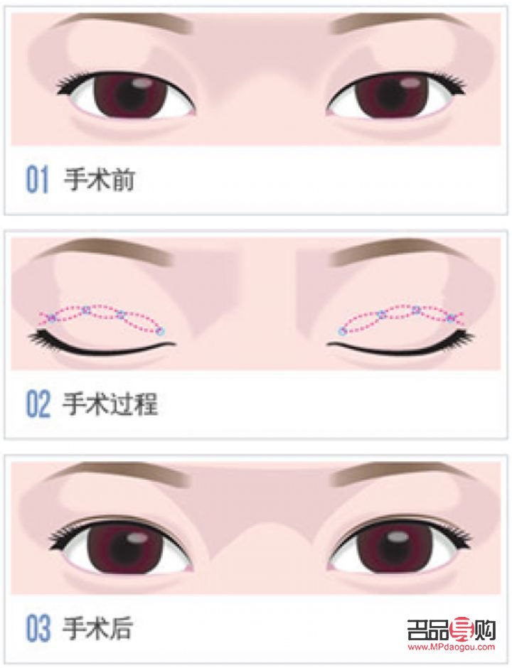 双眼皮手术推荐(双眼皮手术推荐医院) 双眼皮手术推荐(双眼皮手术推荐医院)