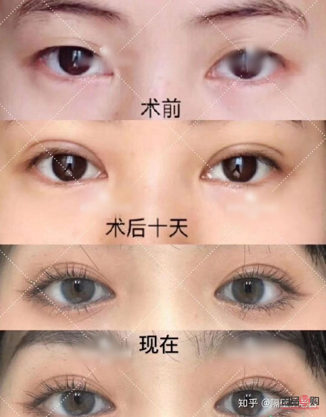 双眼皮手术推荐(双眼皮手术推荐医院)