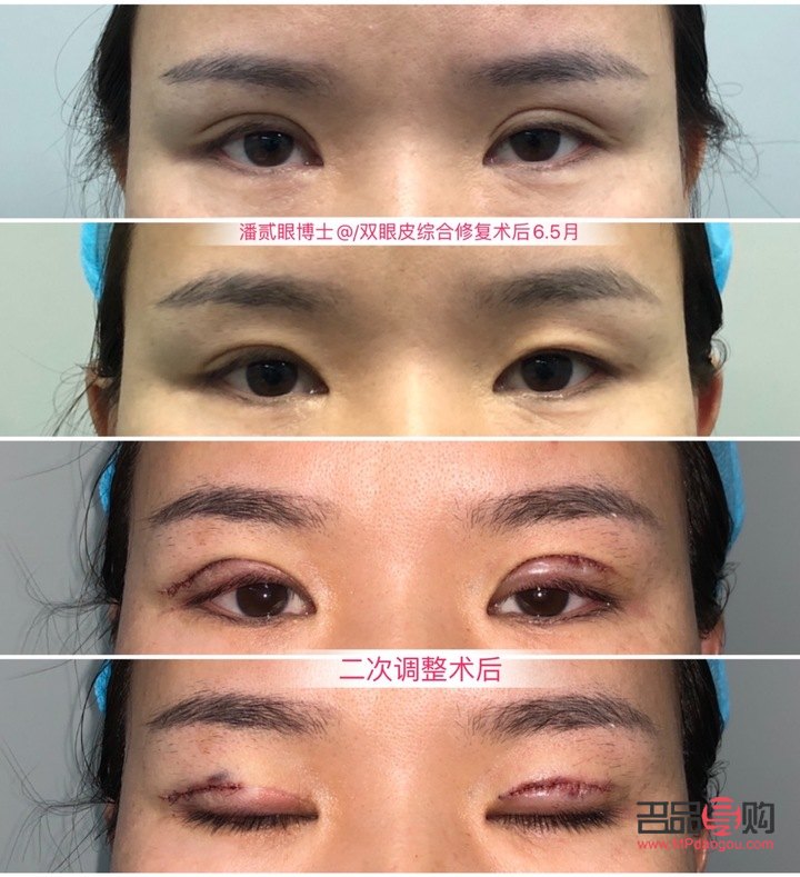 双眼皮眼皮外翻会好吗(双眼皮外翻怎么办)