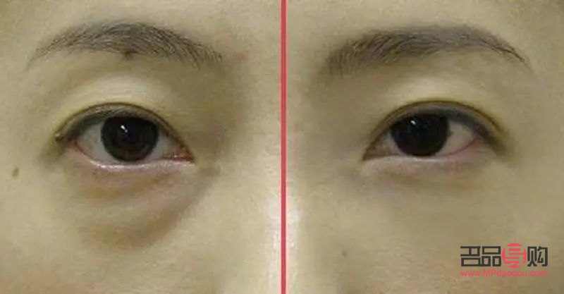 45岁的女人眼袋越来越明显(45岁的女人眼袋越来越明显怎么办)