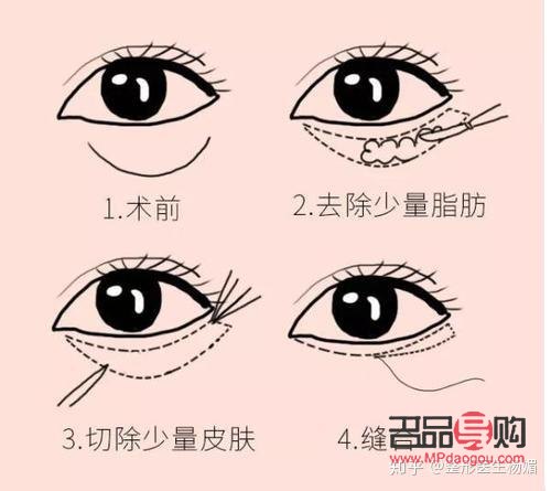 眼综合(眼综合手术包括什么项目) 眼综合(眼综合手术包括什么项目)