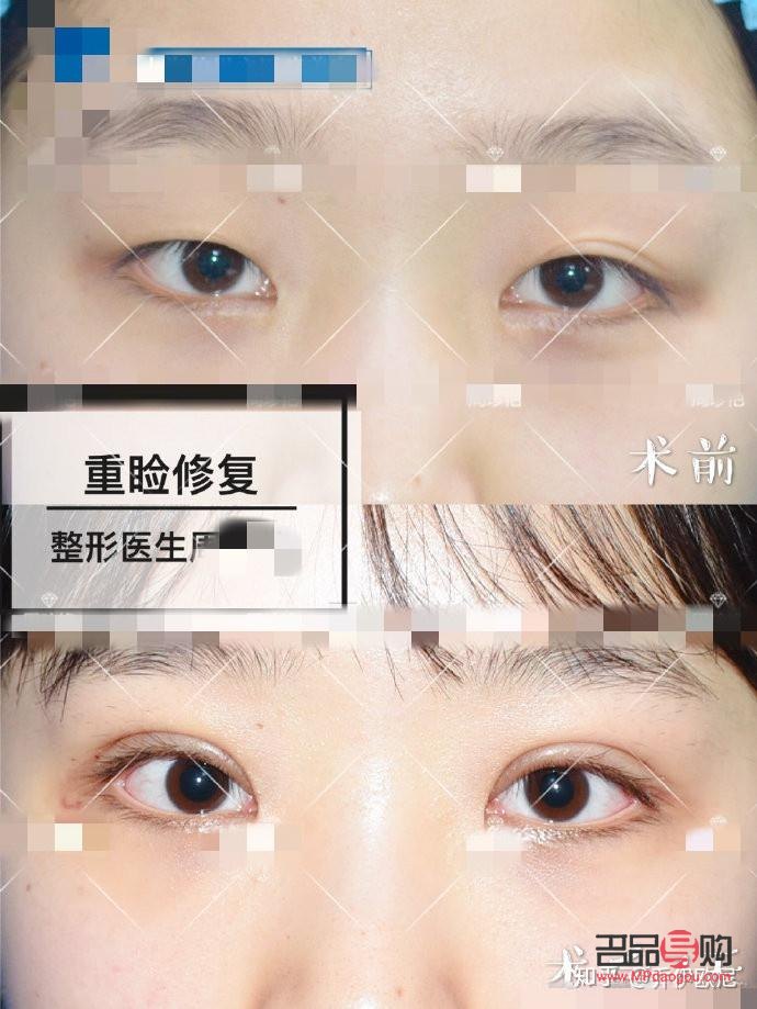 假性双眼皮的特征(假性双眼皮的特征图片)