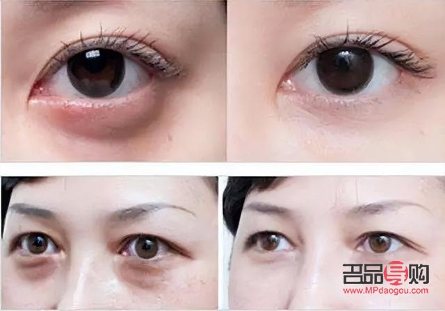 眼袋黑眼圈好重怎么办(眼袋黑眼圈好重怎么办图片) 眼袋黑眼圈好重怎么办(眼袋黑眼圈好重怎么办图片)