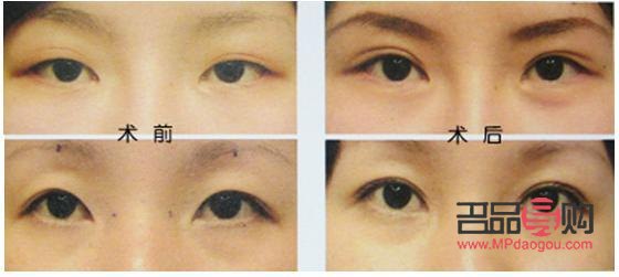 肿眼泡做抽脂手术后会再长回去吗(肿眼泡抽脂后还会长吗)