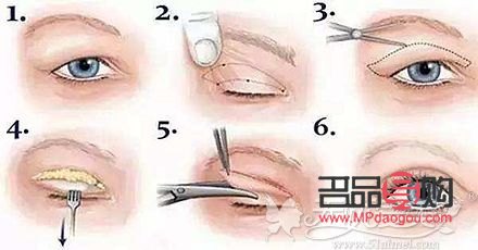 肿眼泡做抽脂手术后会再长回去吗(肿眼泡抽脂后还会长吗)