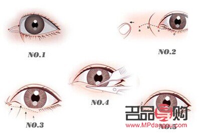 <h3>开眼角与做双眼皮：哪个效果更明显？</h3>