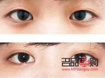 <h3>开眼角与做双眼皮：哪个效果更明显？</h3>