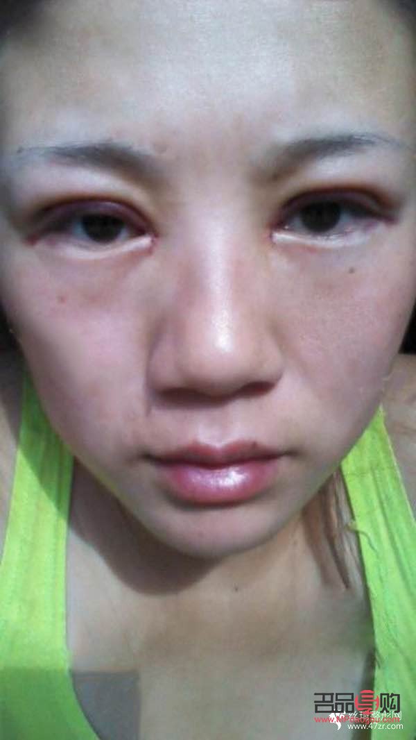 <h3>天生肿眼如何快速消肿</h3>