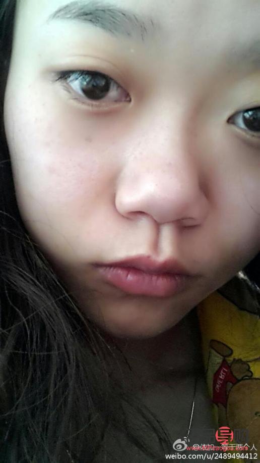 <h3>天生肿眼如何快速消肿</h3>