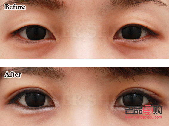 双眼皮整形：选择哪家医院更靠谱？