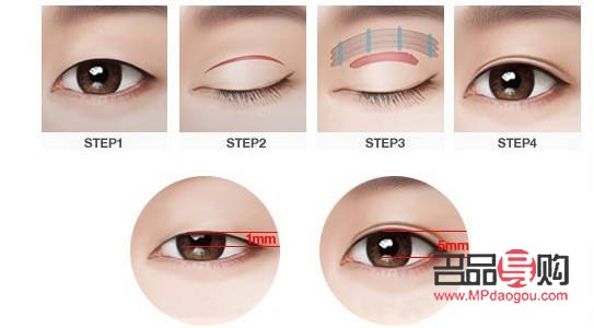 割双眼皮对身体的影响：风险与考量