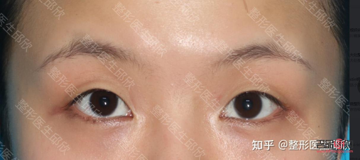 内双眼皮是啥样的(内双眼皮是啥样的图片)