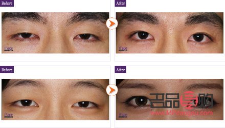 50岁眼皮下垂怎么改善(50岁眼皮下垂怎么改善图片)