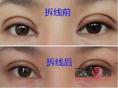 全切双眼皮恢复之路：时间与自然的完美融合