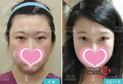 双眼皮改单眼皮：成功案例与探索之旅