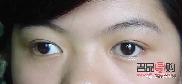 <h3>一只眼睛眼珠歪了：原因、影响与解决方案</h3>