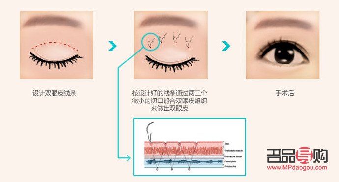 双眼皮有几种款式价格(双眼皮有哪几种款式) 双眼皮有几种款式价格(双眼皮有哪几种款式)