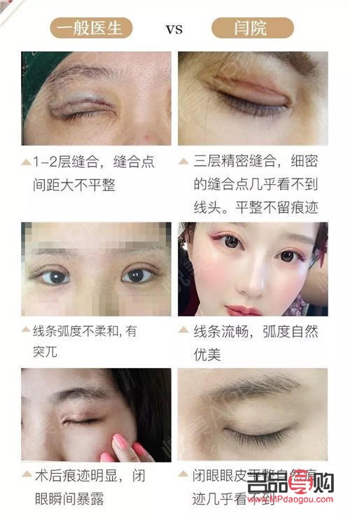 有双眼皮可以再割吗(有双眼皮可以再割吗图片)