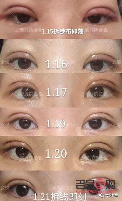 有双眼皮可以再割吗(有双眼皮可以再割吗图片)