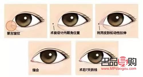 开外眼角手术前后惊艳对比