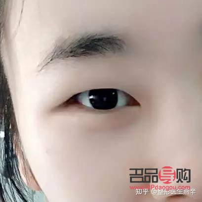 肿眼泡应该怎么改善(肿眼泡怎么改善啊)