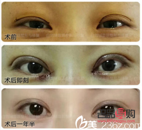 双眼皮美容价格(双眼皮美容价格表图片)