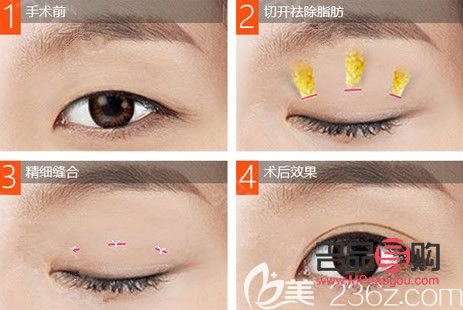 双眼皮美容价格(双眼皮美容价格表图片)