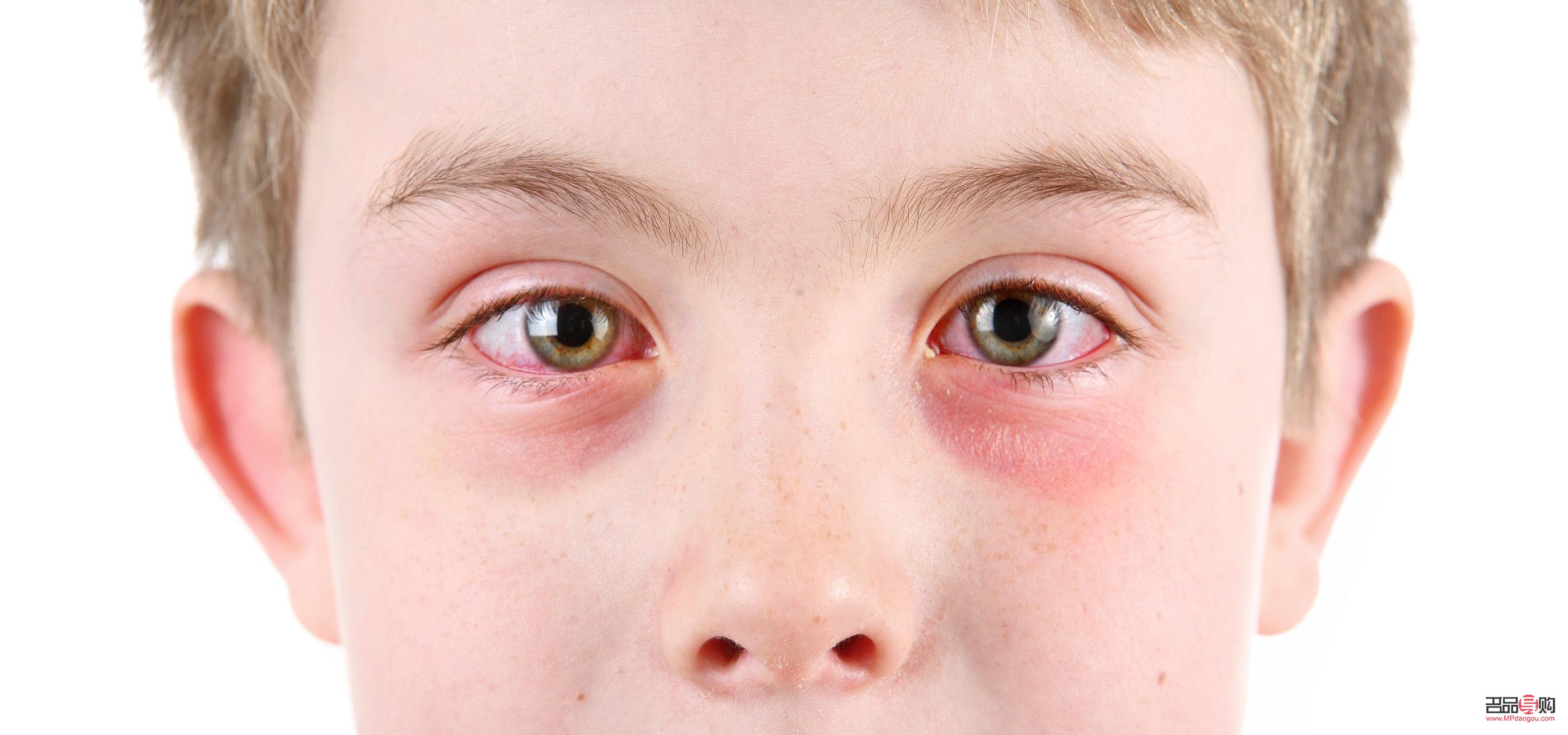 早上起床眼睛浮肿怎么回事(最近早上起床眼睛浮肿怎么回事)