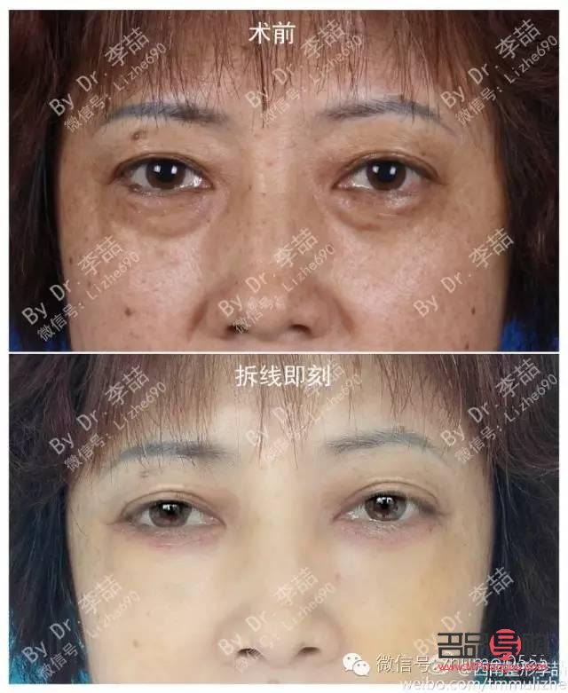 去眼袋眶隔释放安全吗(眶隔释放泪沟填充能保持几年)