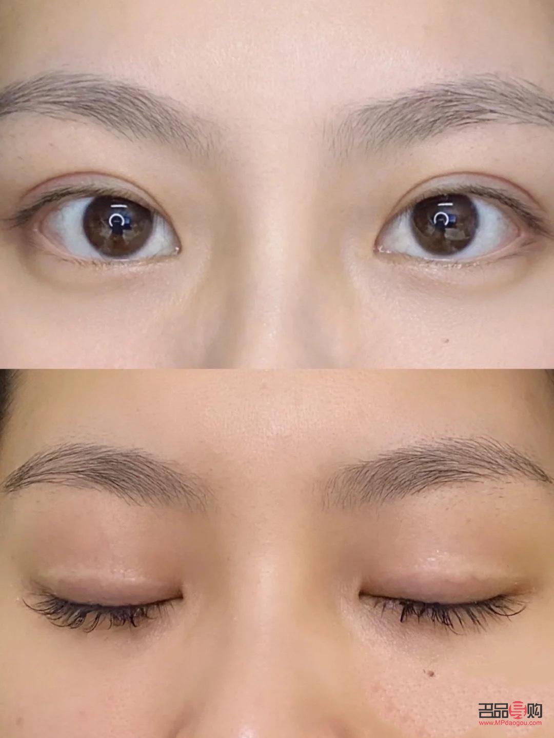 无痕双眼皮是什么意思图片(无痕双眼皮是什么意思图片女)