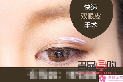 无痕双眼皮是什么意思图片(无痕双眼皮是什么意思图片女)