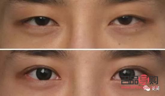 如何提升上眼皮肌肉(如何提升上眼皮肌肉层次)