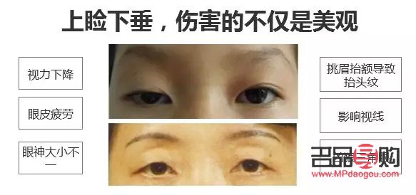 如何提升上眼皮肌肉(如何提升上眼皮肌肉层次)