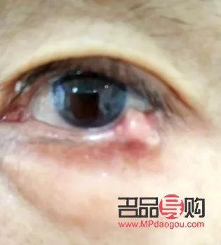 <h3>探索下眼睑纹去除之道，重拾眼部青春魅力</h3>