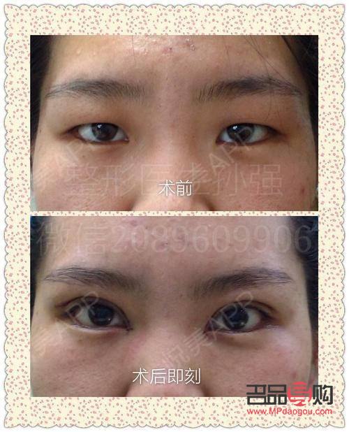 肿眼泡割双眼皮自然吗(肿眼泡可以只抽脂不割双眼皮吗)