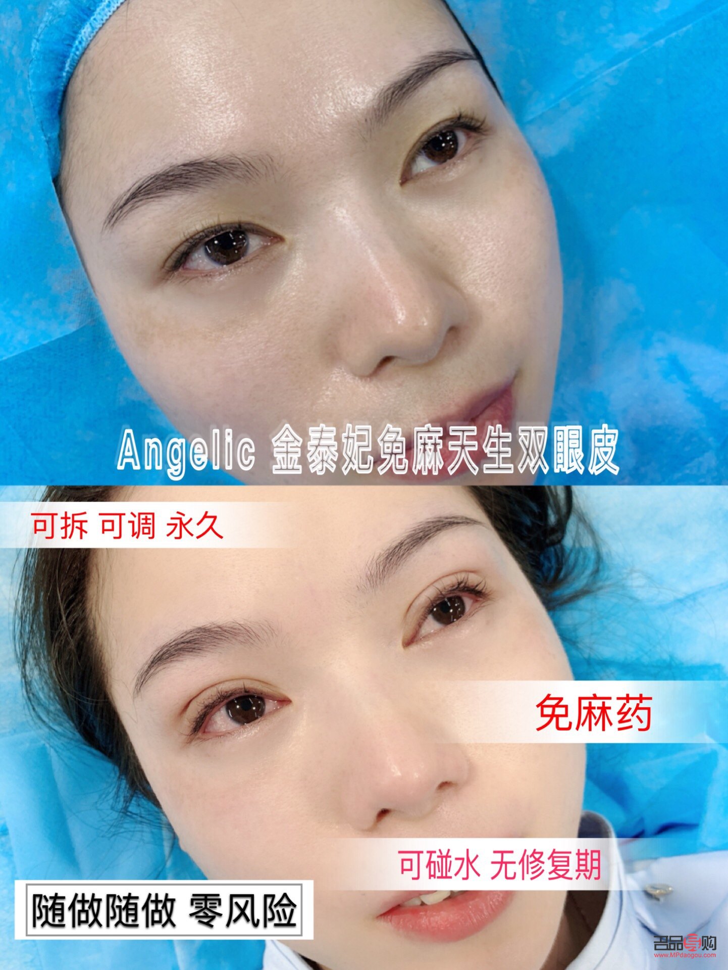 免麻无痕双眼皮手术风险解析