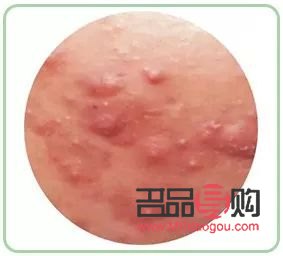 身体火烧怎么护理(身体火烧怎么护理最好)