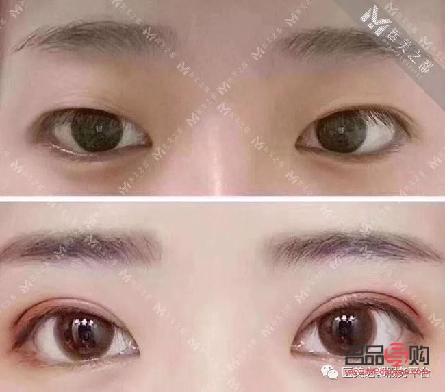 双眼皮类型有哪些图片大全(双眼皮类型有哪些图片大全图解) 双眼皮类型有哪些图片大全(双眼皮类型有哪些图片大全图解)