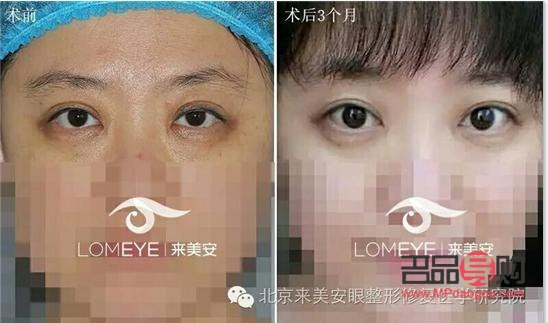 双眼皮一边宽一边窄怎么修复好(双眼皮一边宽一边窄怎么修复好呢)